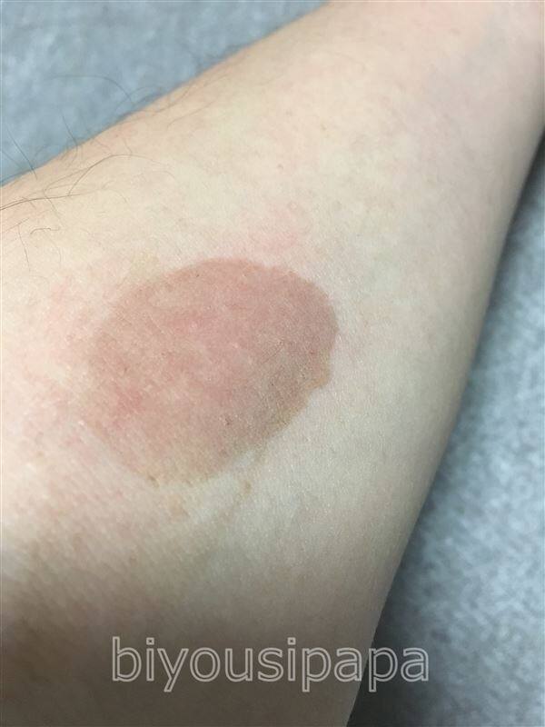 白髪染めのアレルギー症状