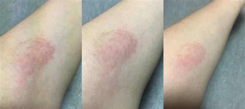 白髪染めのアレルギー症状